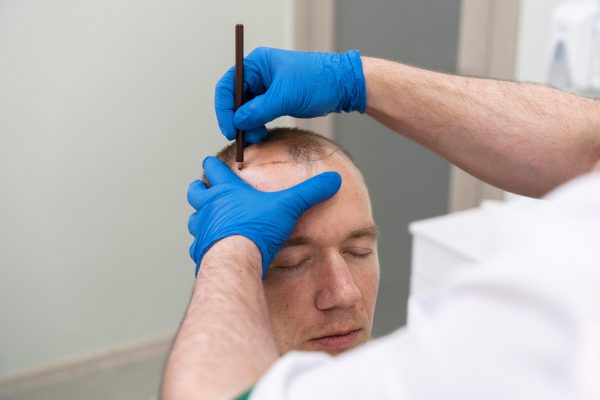 La greffe capillaire : ce qu’il faut savoir avant de passer le cap et comment ça fonctionne