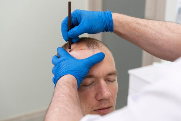 Greffe capillaire : ce qu’il faut savoir avant de passer le cap ?